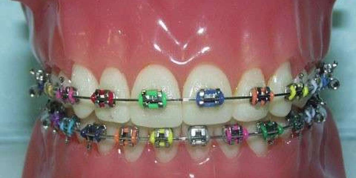 Transform Your Smile with the Best Braces Dentist in Singapore: Smile Doctor Clinic