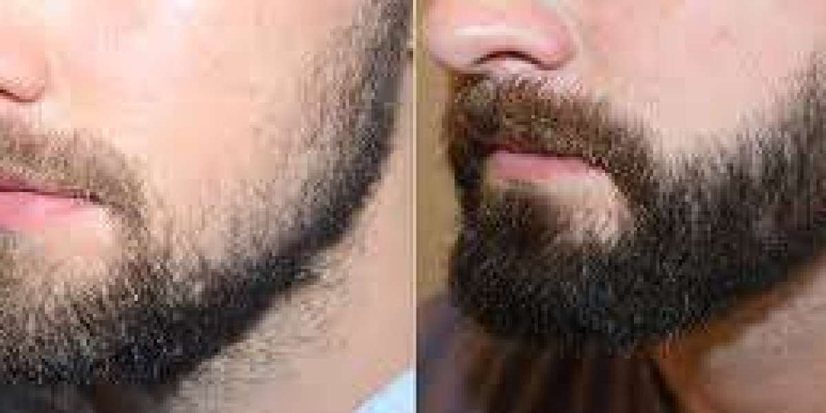 Does Beard Growth Transplant Really Work for Thin Beards?