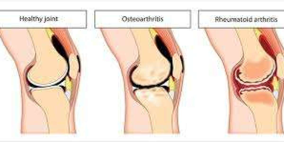 Rheumatoid Arthritis (RA): Causes, Symptoms, and Treatment