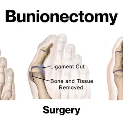 Bunionectomy (Chevron Bunionectomy) Profile Picture