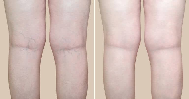 Refresh A Top Laser Vein Treatment in Florida