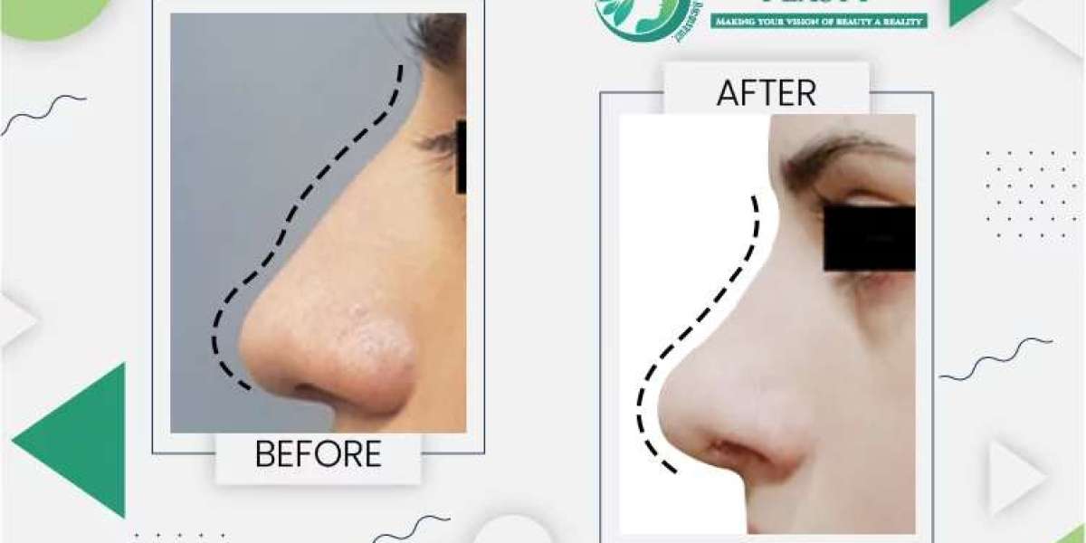 Choosing the Best Rhinoplasty Surgeon in Lahore for Your Nose Surgery