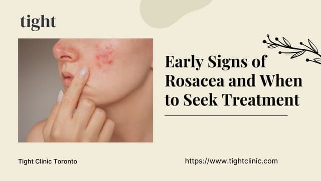 Understanding Rosacea - Early Signs and Treatment Options | PPT