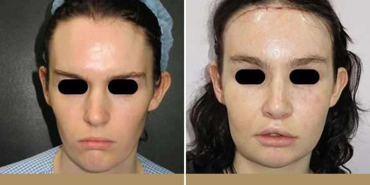 5 Transformations One Can See After Facial Feminization Surgery
