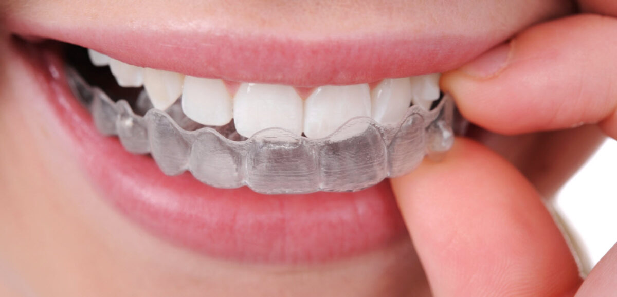 Why Invisalign in Camarillo Is the Smile Trend of the Year - Press Release Submission Sites Free, Free Instant Approval Guest Posting Sites