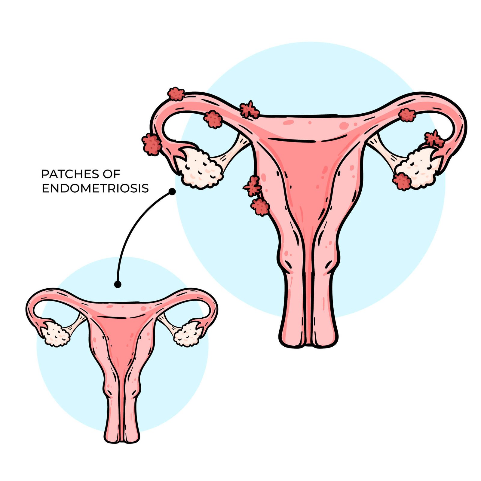 What is Endometriosis? Understanding the Basics and Early Signs - Health