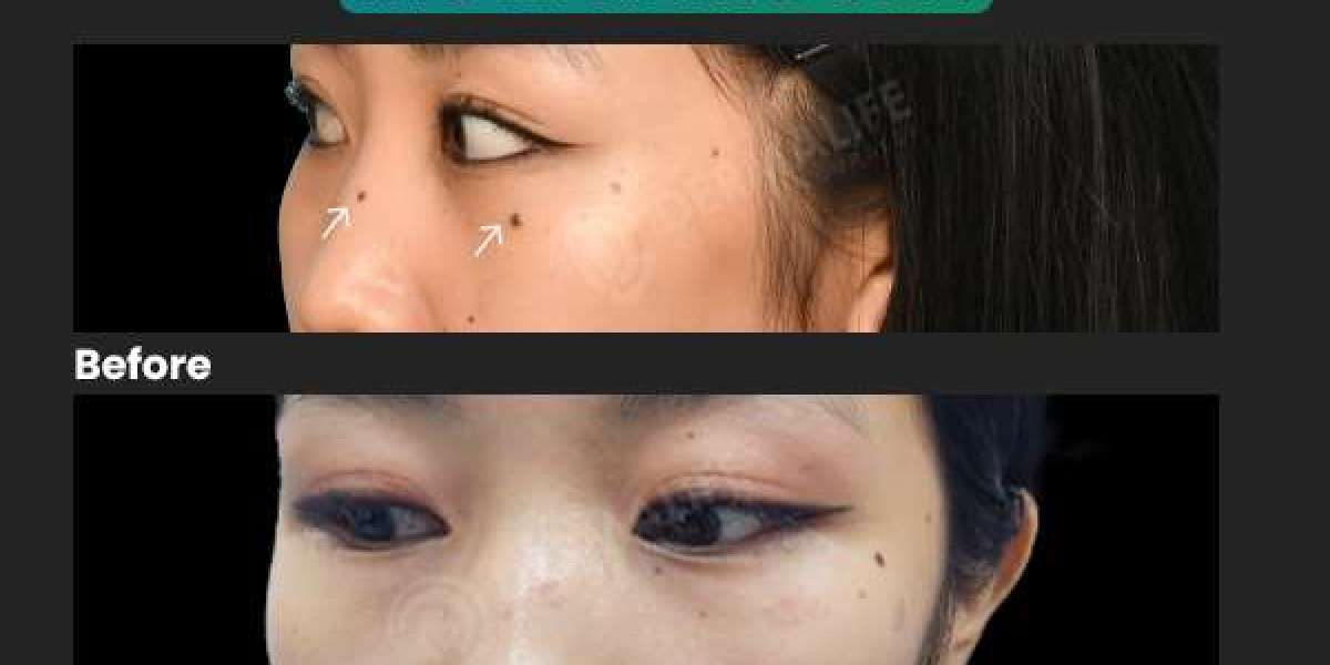 Mole Removal: How to Prepare, What to Expect, and Aftercare