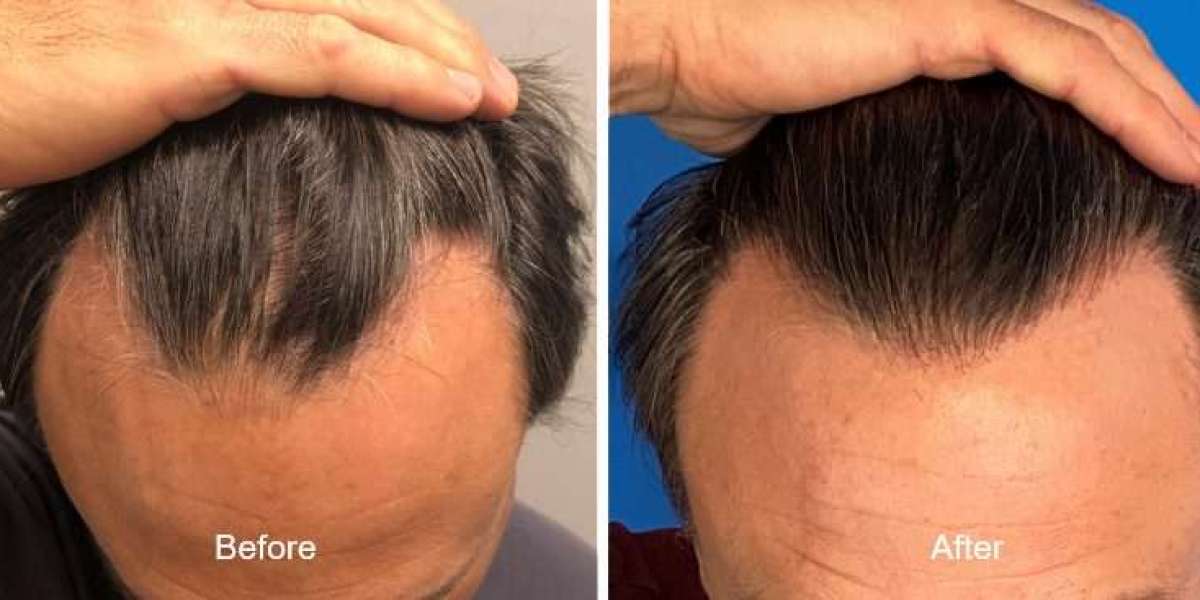 Ontdek de Voordelen van een DHI hair transplant Albania vanuit het Verenigd Koninkrijk