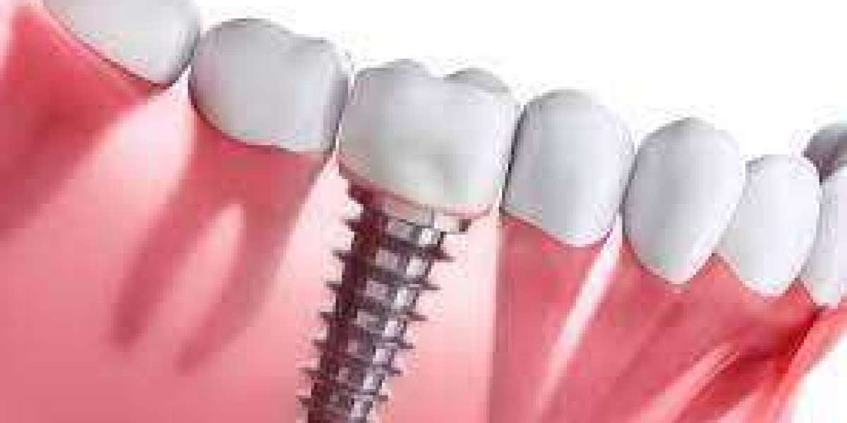 Todo lo que debes saber sobre el tratamiento de implantes dentales