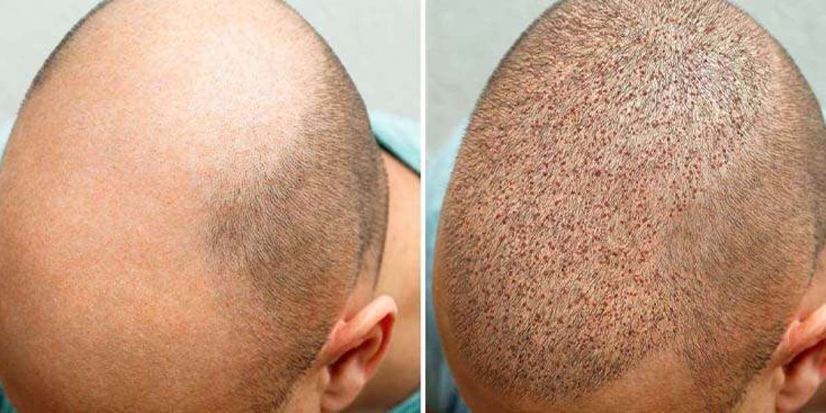 Complete gids voor de beste hair transplant packages Albania voor inwoners van het Verenigd Koninkrijk