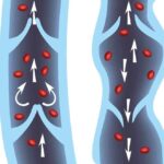 Myths on Varicose Vein Treatment Costs Debunked - Tumblrblog