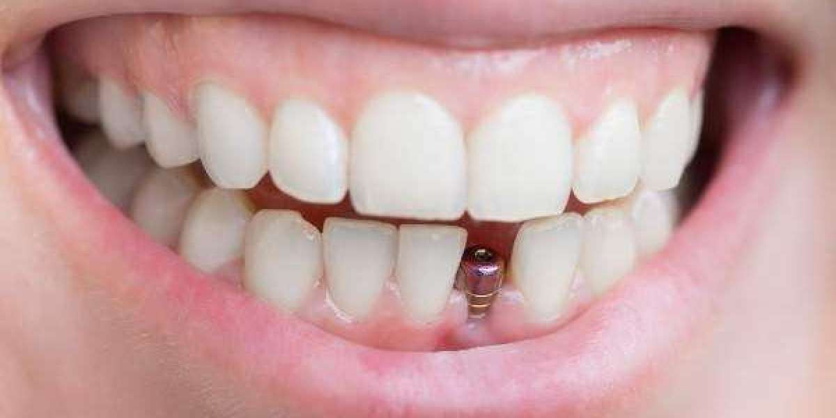 New Implant Approaches for Effective and Gentle Treatment