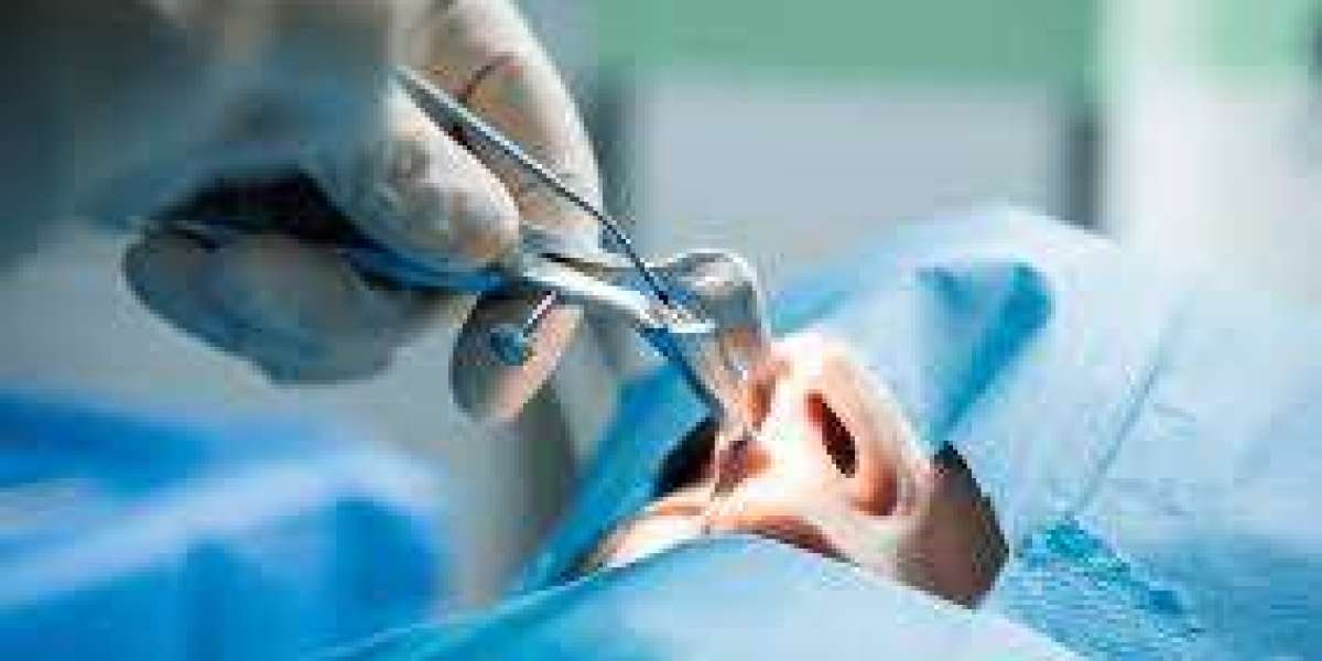 Expert Turbinate Reduction in Los Angeles: What You Need to Know