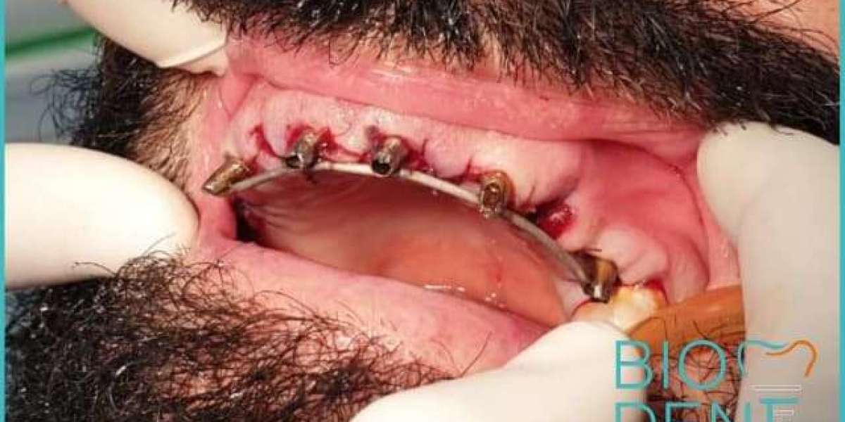 L’Eccellenza degli Impianti Dentali Albania: La Soluzione Ideale per un Impianto Dentario Perfetto